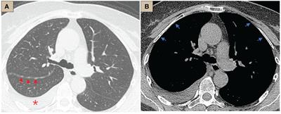 A case report of typical well-differentiated papillary mesothelial tumor diagnosed by internal thoracoscopy and literature review